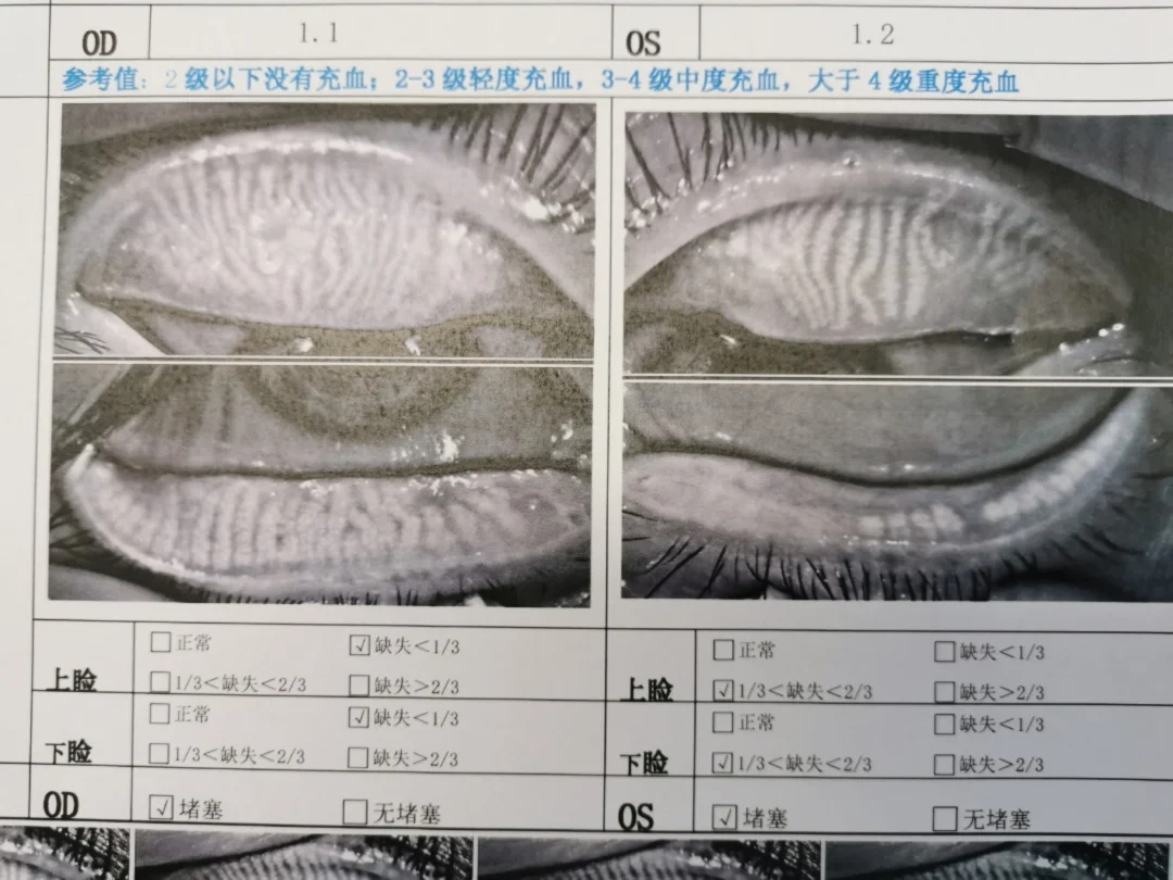 给大家看看不健康的睑板腺的样子：腺体形态不好，变细，有萎缩和缺失。缺失的地方小时
