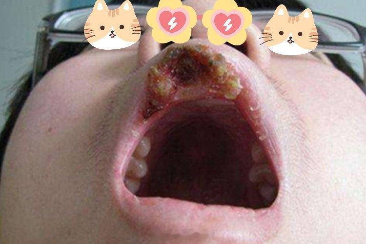 #男子大腿长红斑以为是股癣一查是梅毒#梅毒是由梅毒螺旋体引起的慢性传染病。早期症状就算不治也会自己消失，但病其实没好，病原体还在体内扩散。梅毒分三期，各期表现不一样。

一期：硬下疳
梅毒螺旋体通常从性接触的部位进入身体，比如生殖器、肛门、口腔。它在局部繁殖后，会出现一个典型症状，硬 ​