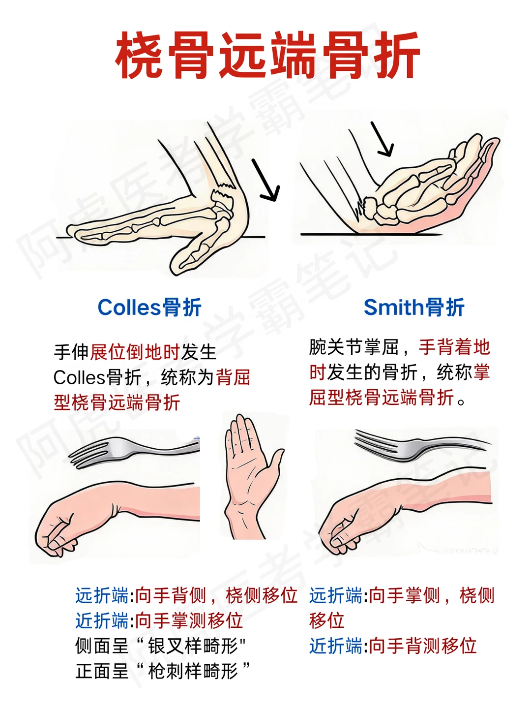 阿虎医考笔记📒桡骨远端骨折❤️