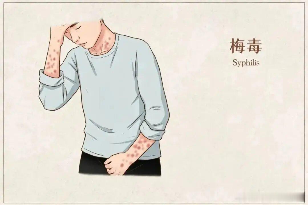 #男子大腿长红斑以为是股癣一查是梅毒#浙江杭州48岁张先生，大腿、腹股沟、会阴长出红斑伴随脱屑瘙痒，他自行当成股癣涂抹药膏，半个月症状没有好转。就医检查发现，张先生手掌也出现不痛不痒的红斑，结合病史，最终确诊二期梅毒。
 
医生介绍，梅毒被称作皮肤科的“模仿大师”，临床表现多样，皮疹形 ​