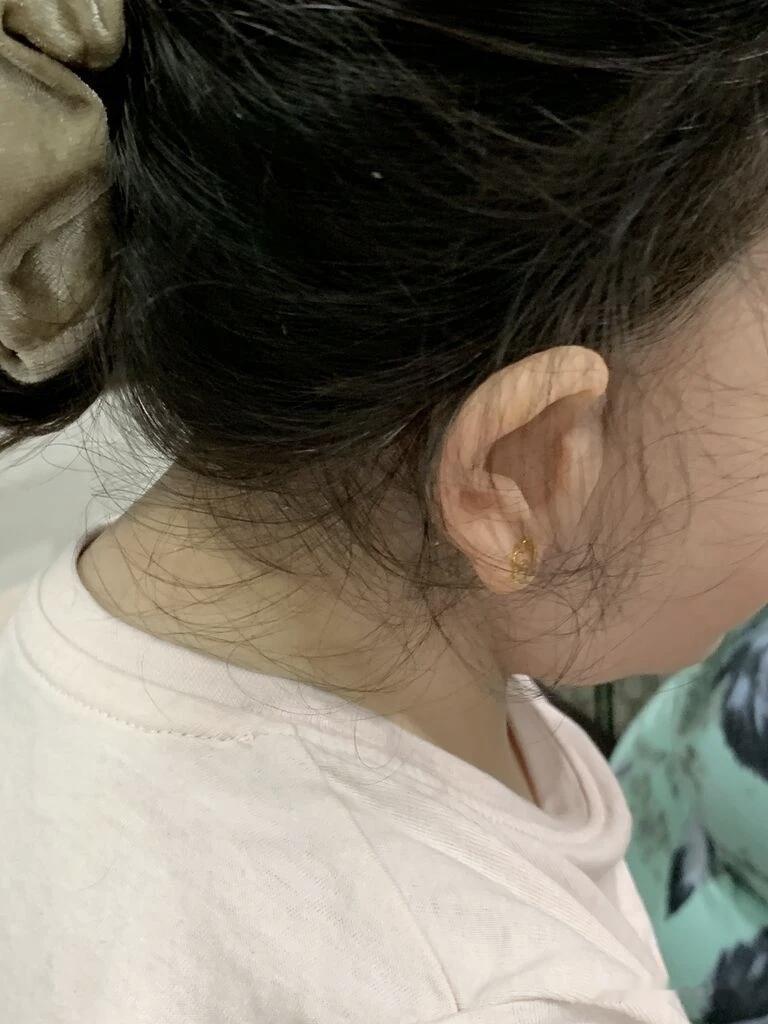 硅胶义耳体表仿生：赝复师刘刚的手艺分享
⚠️声明：本文仅为手工工艺纪实分享，非医疗广告，不构成任何诊疗建议。
 
很多人不太了解体表硅胶仿生这个小众领域。
这是赝复师刘刚的一副硅胶义耳作品展示。
 
这里有一个很重要的概念需要厘清：
硅胶义耳属于外观向的仿生假体，它不是医疗手术，不能从生理上修复耳廓