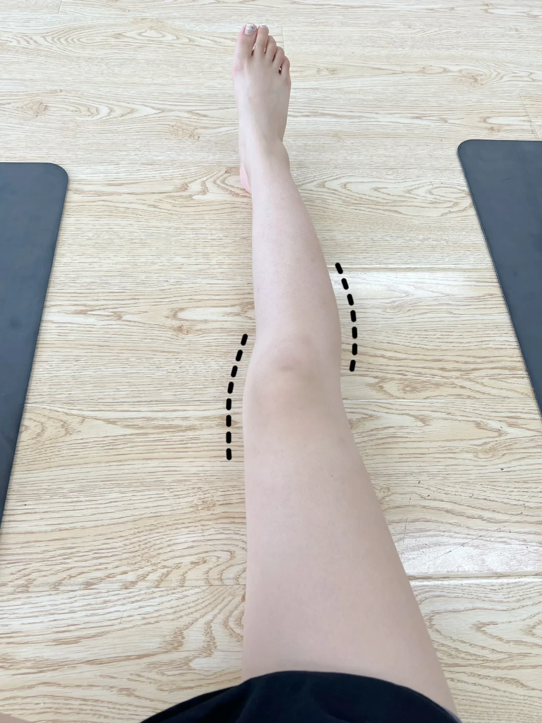 服了!原来是膝内侧凸在搞鬼，5个动作直腿！