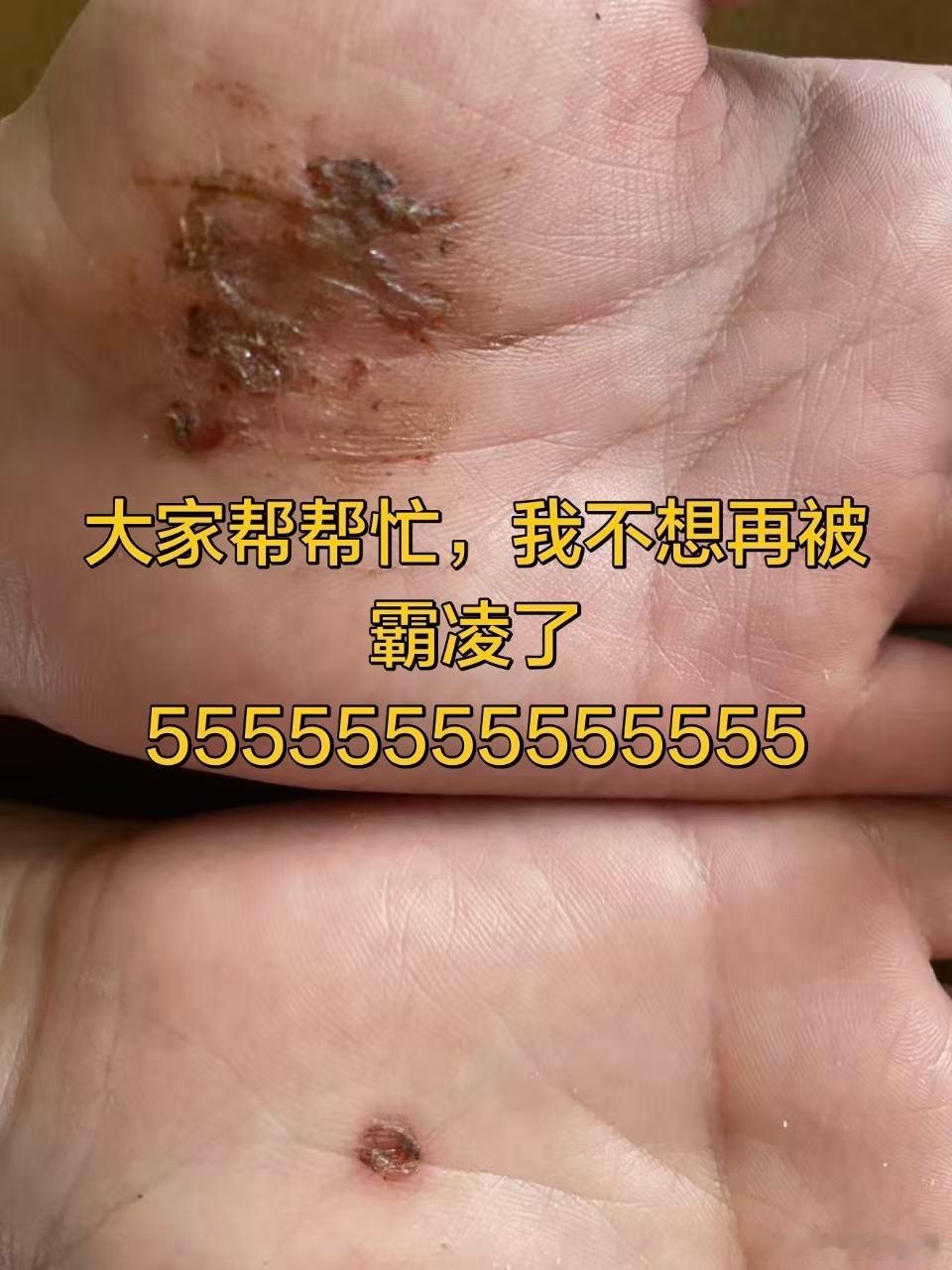 #好好吃饭##阳泉##霸凌## #阳泉市北大街小学[超话]# 2026年9月9日中午放学后，北大街小学五年级学生小李的左手打着十字白色绷带，回家路上妈妈见到后问询得知是班上在全校有名的捣乱孩子小陈无端欺负孩子所致，回家后仔细查看伤口，左手伤口严重，皮下软组织大面积暴露，右手伤情相较稍好，仅裸露表层 ​