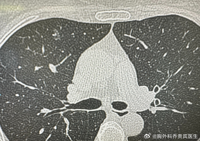 肺结节切了又长，什么时候才能结束？这是一位55岁患者的真实经历。三年前...