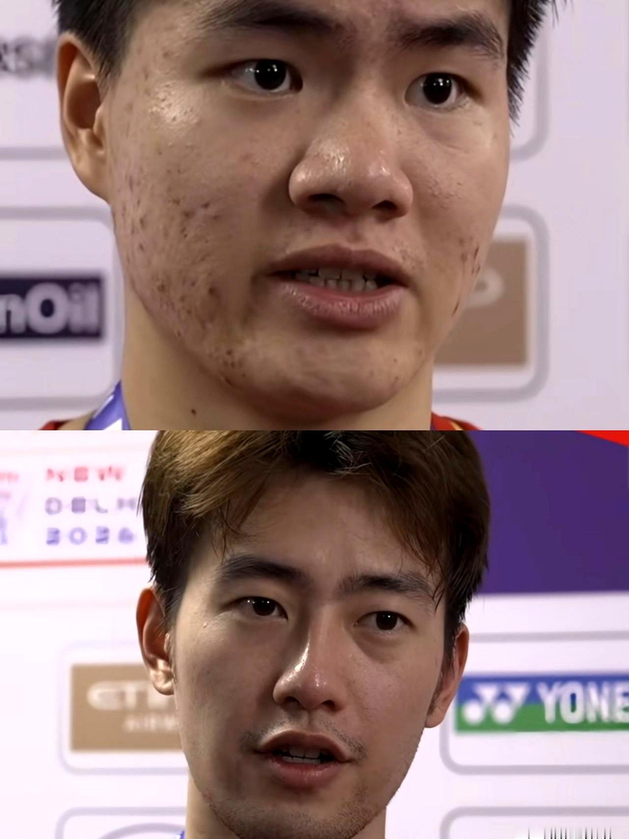 梁王组合把羽毛球锦标赛男双拿下那瞬间，弹幕已经把今年亚运会的金牌、2028年洛杉矶奥运会的男双冠军一并塞进他们兜里了。
镜头一转，王昶脸亮得像抛了蜡，笑里带风；梁伟铿这张脸，确实比前阵子平了点，可痘痘与痘痕还在，有人说是内分泌，话题越炒越热。

见过反面教材，赛季密集时，航班、汗水、熬夜，年轻人的皮