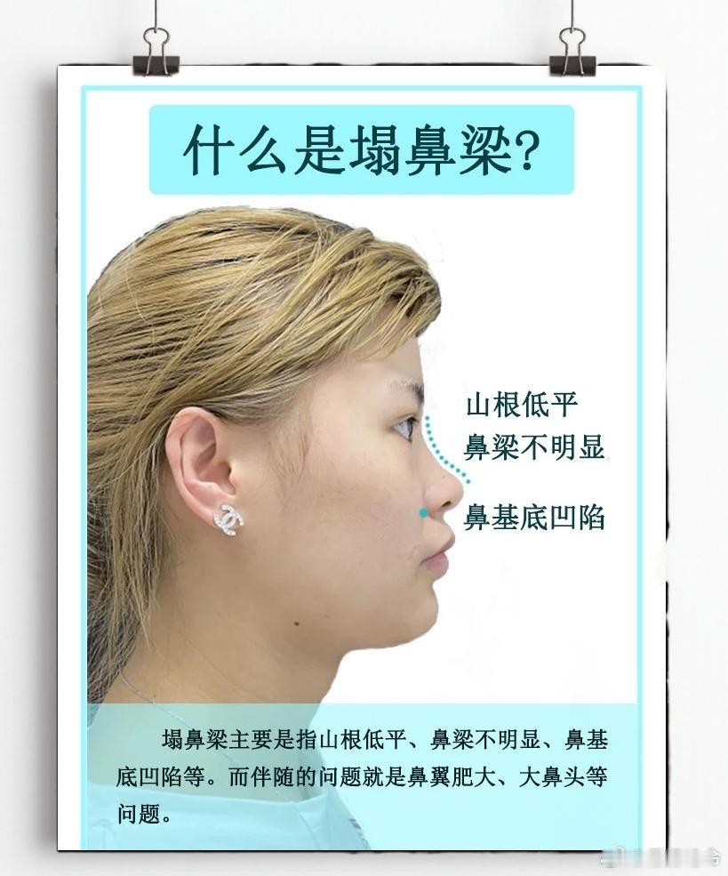塌鼻梁的面相有哪些不利一、性格与心智不吉• 缺主见、优柔寡断：遇事犹豫，不敢担责，容易随波逐流，难成大事。• 自卑怯懦、魄力不足：自信心弱，不爱表现，有苦常闷在心里，压力大。• 依赖性强、少进取心：适合做辅助、后勤类工作，少开创精神，容易安于现状。二、事业与财运不吉• 事业难出头、少贵人：鼻为“财帛宫”，塌鼻主根基弱、缺贵气，中年运平平，难掌权、难发大财。• 多劳少得、挣钱辛苦：挣钱费劲，易遇阻碍、小人，存钱难，易有破财、漏财。• 难承祖业、白手艰难：山根低陷主祖上缘薄，难靠长辈助力，多要自己打拼。面相博主算命博主占卜陪玩超话塔罗预测整容日记占卜者
