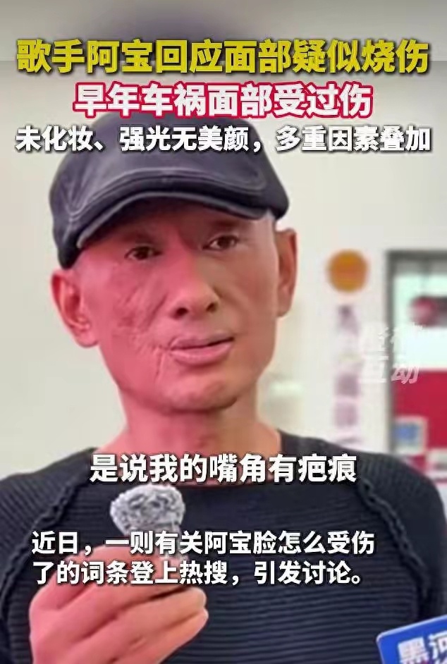 57岁歌手阿宝脸部疑似被烧伤，本人回应：嘴周疤痕是一次意外车祸所致，我快60岁了，早已不注重形象管理了
10月12日，阿宝本人发视频回应关于“阿宝的脸和嘴怎么了”的相应问题称，嘴周疤痕是一次意外车祸所致，十多年前做客央视《艺术人生》节目时，就曾讲过这段经历。
网传面部像烧伤的画面，是因为当 ​