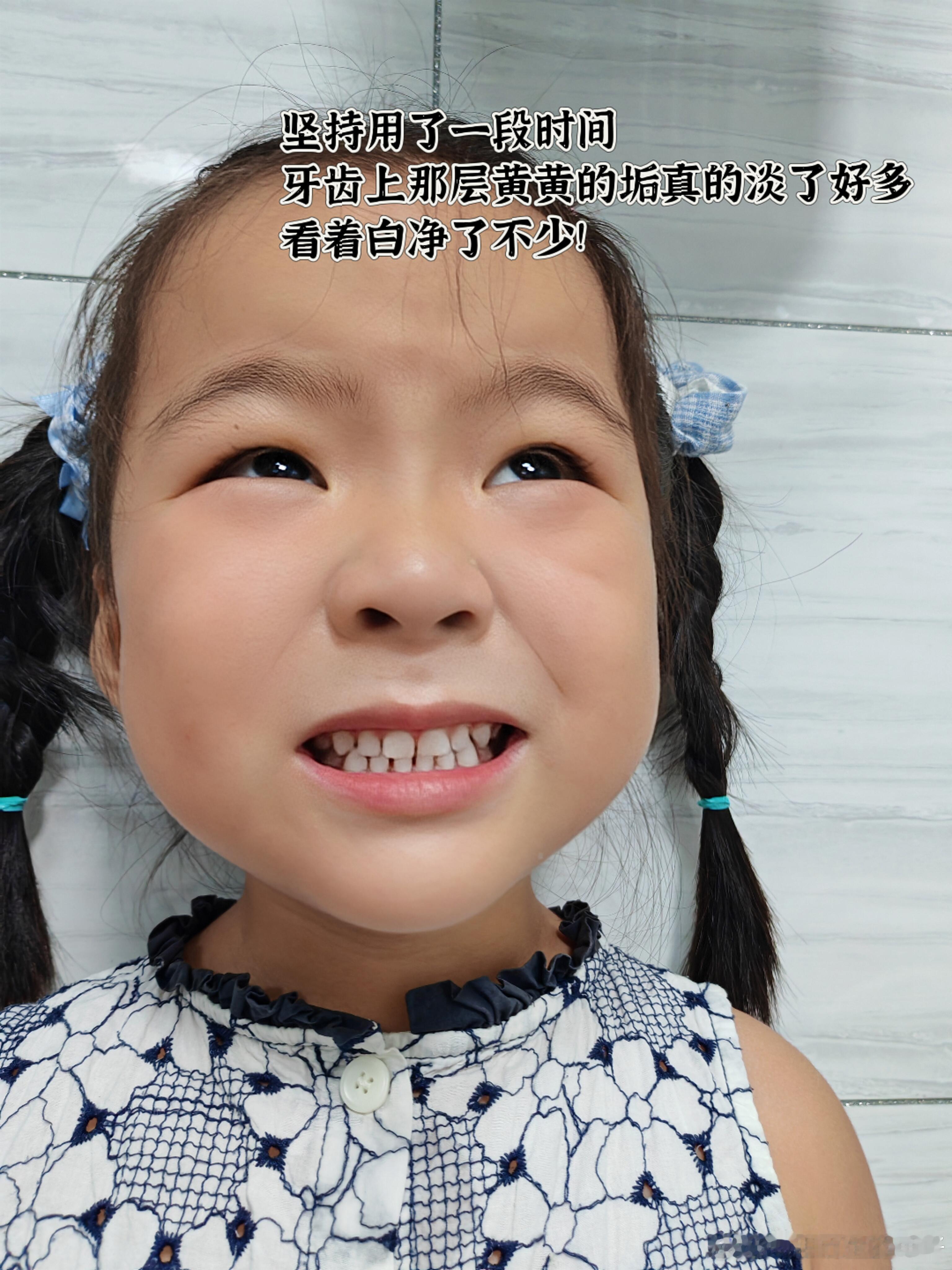 #白岩松谈儿童蛀牙危害#
🦷爱牙日，聊聊我给孩子防蛀牙这件事
今天是920全国爱牙日，看到央视网携手白岩松老师、中疾控专家和北大口腔专家一起科普儿童防龋知识，作为妈妈的我深有感触。趁着这个日子，也想认真聊聊我在孩子护牙这条路上的心得和踩过的坑。💕

🌱曾经的误区：乳牙反正是要换的
说 ​