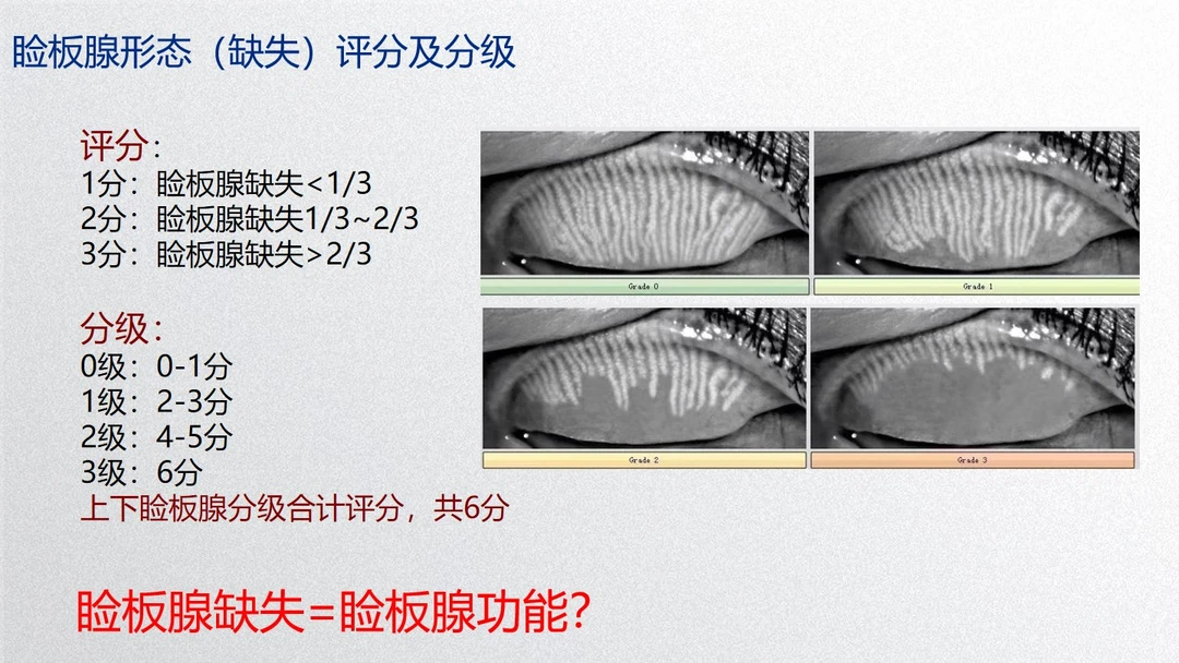 睑板腺缺失评分及分级