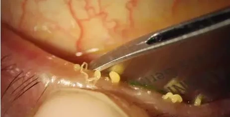 干眼患者，睑板腺功能障碍，该怎么治疗？