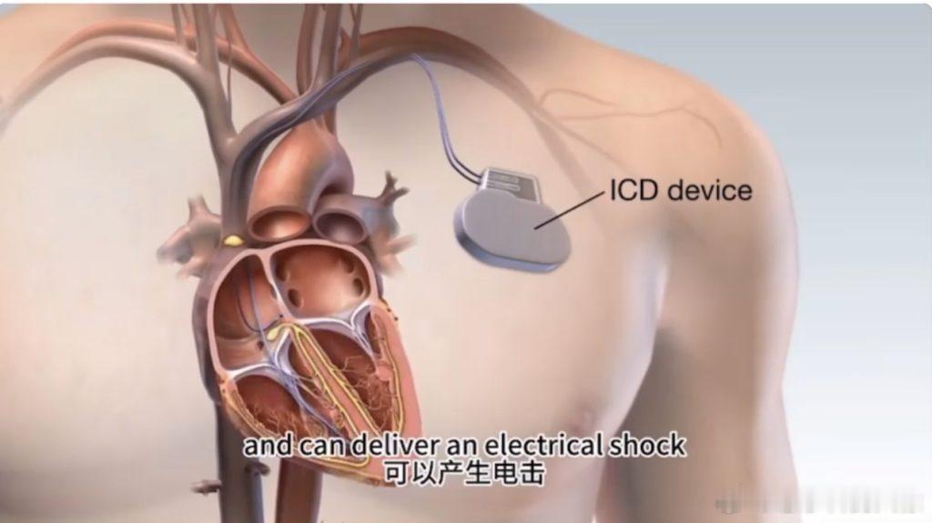 微博陪你看世界杯埃里克森在比赛中晕倒我的健康观赛副本ICD，全称植入式...