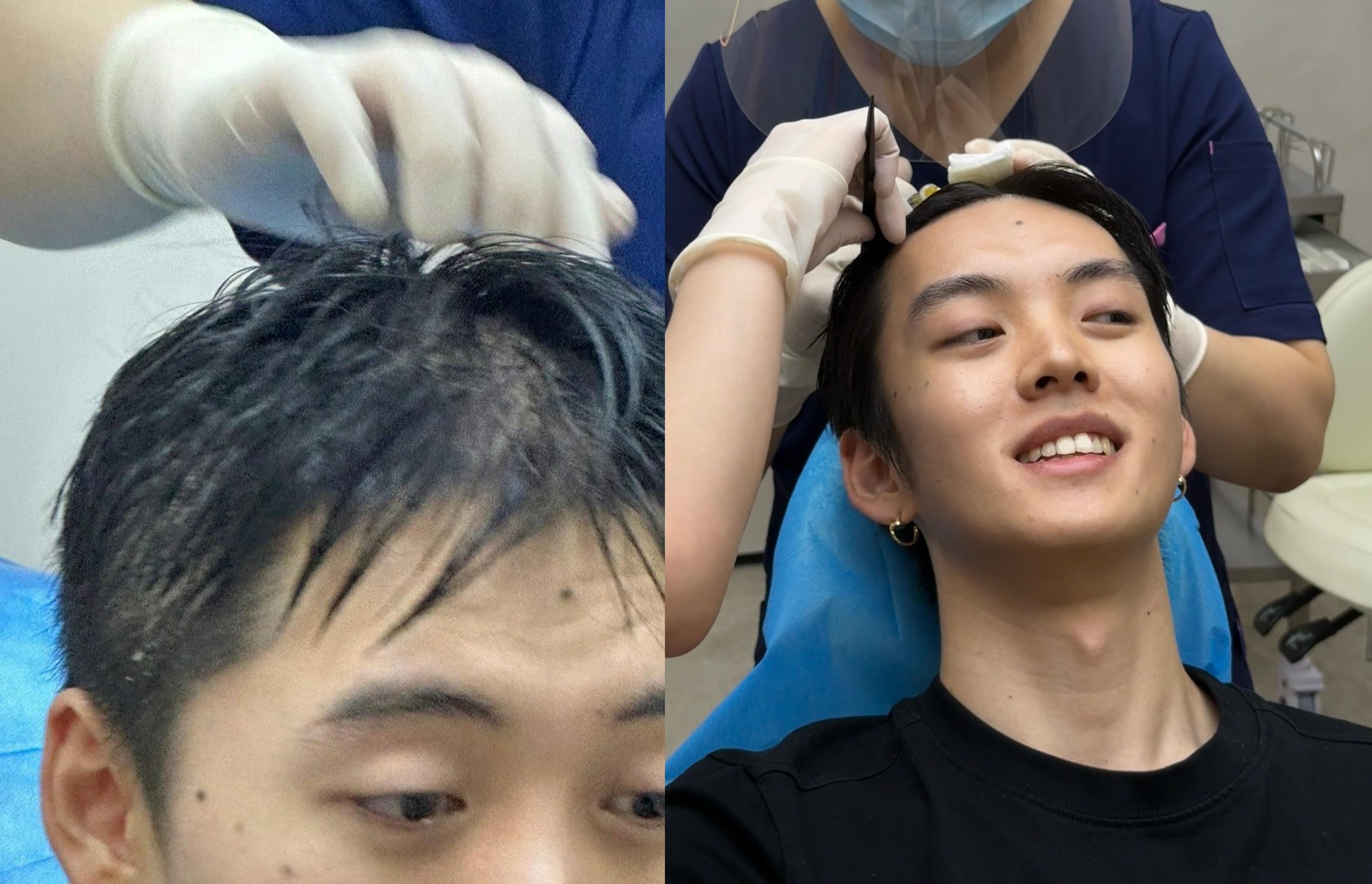 两年前带54打过一次头皮，他疼到流眼泪。这次被我拽过来找王打cgf，我一直说王打cgf头皮不疼，结果他一路都在暗示我“bb能不能不打”，“感觉今天不舒服”…结果打到一半他笑出来了[淡淡的]刚刚回到房间马上问我，这个我可以每个月都来打，bb 在哪里下单[打脸] ​​​