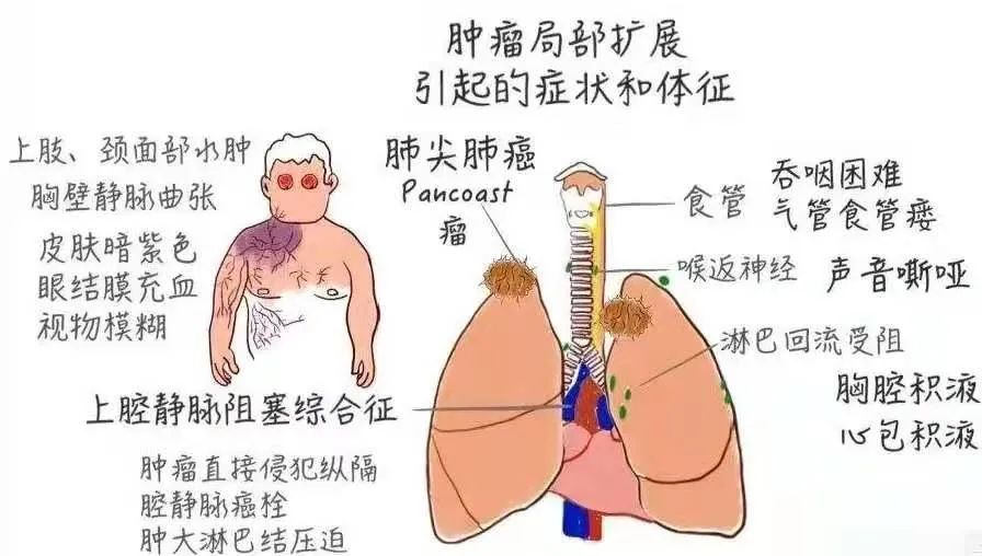 钟南山团队新发现：不抽烟也会查出肺结节
 
钟南山团队研究发现，71%肺结节患者没有吸烟史；约73%肺癌病例，并不属于传统认知里的高危人群。很多人一直认为，只有长期抽烟的人，才会出现肺部病变。
 
烟草确实是伤害肺部的重要因素，但它不是唯一因素。日常做饭产生的油烟，空气中持续存在的粉尘，装修残留的刺