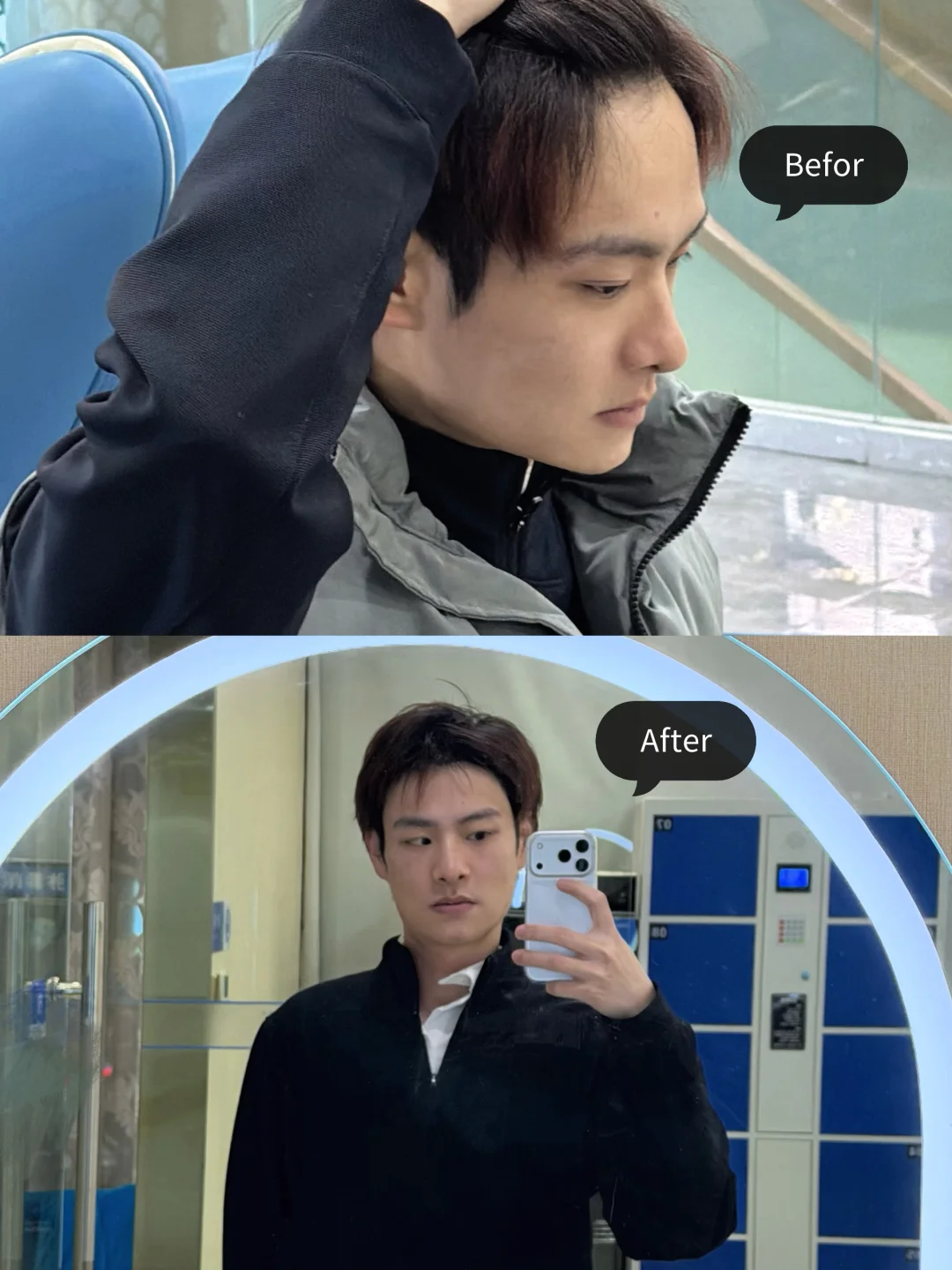 拜拜了大额头，不剃发植发真的没有尴尬期！