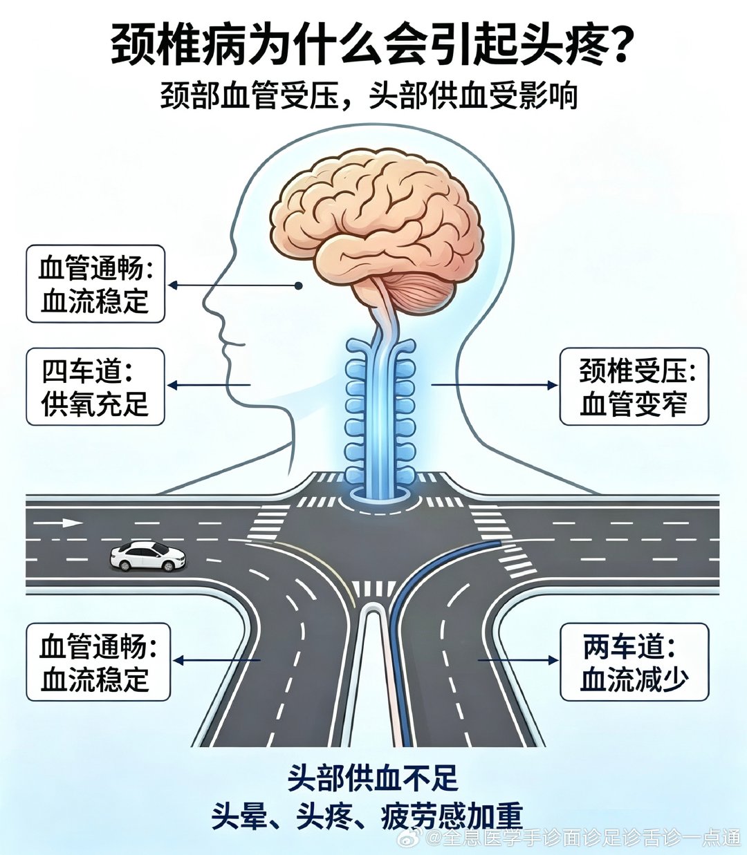 #国医的精诚力量# 
颈椎病为什么会引起的头疼⁉️
把我们的身体想象成一条马路
交警偷懒不去疏导
道路就会慢慢拥堵，越堵越严重
颈椎就是人体的十字路口
往上连通大脑，左右连通手臂  ​