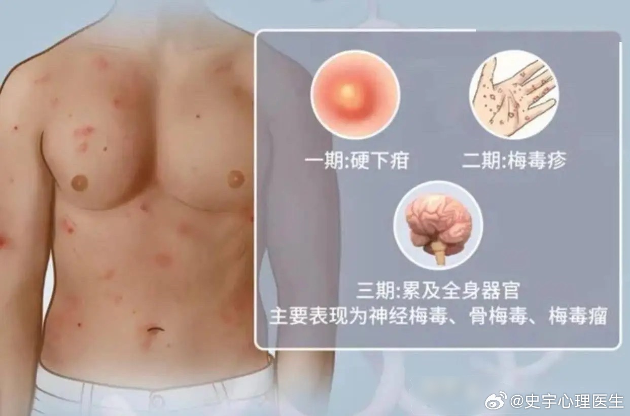 #梅毒越来越困扰年轻人#很多人对梅毒的印象，还停留在会出皮疹、溃烂。但现实里绝大多数感染者，没有任何不舒服的感觉。

国内梅毒报告病例常年处在高位，2025年全年报告约64万例，90%以上是隐性梅毒。
隐性梅毒也就是潜伏梅毒：抽血检查阳性，但身上没有溃疡、红疹等典型症状，感染者自己完全察觉不到 ​