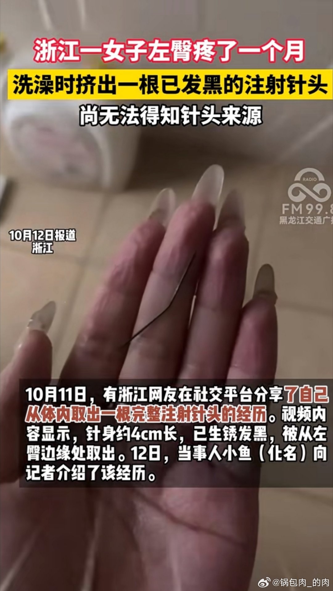#女子左臀疼1个月挤出发黑注射针头#注射针头赶紧去查血吧，一根四五厘米、发黑生锈的注射针头，断针，在人体内滞留、生锈、游走折磨一个月，光是想想都生理性恐惧 ​
