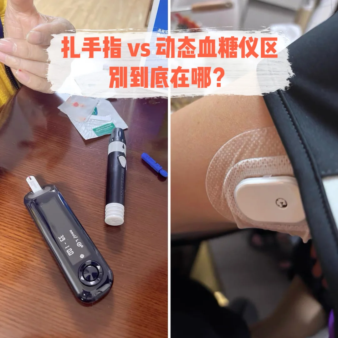 扎手指 vs 动态血糖仪，区别到底在哪？