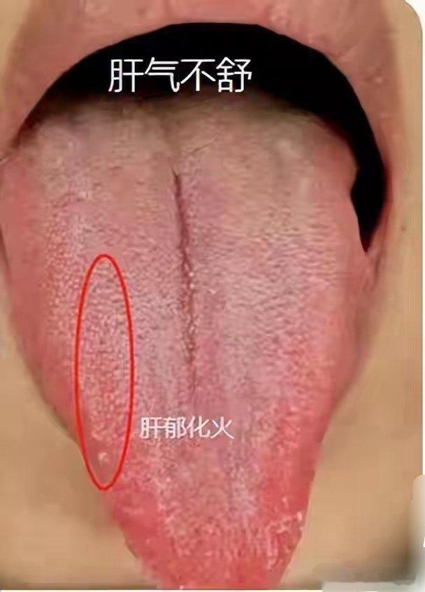 肝气不舒的舌象辨证分析，首先属于典型苹果舌，舌尖中间有凹陷，像苹果手机标志一样，这种情况需要先确认是否舌下系带过短，要是过短，就是苹果舌的原因之一。若排除过短，苹果舌说明腰部会有酸痛感，这是心阳不足，无法濡养下焦导致的。舌前肺区以舌中为界，两边出现对称裂纹，意味着可能有梅核气、咳 ​