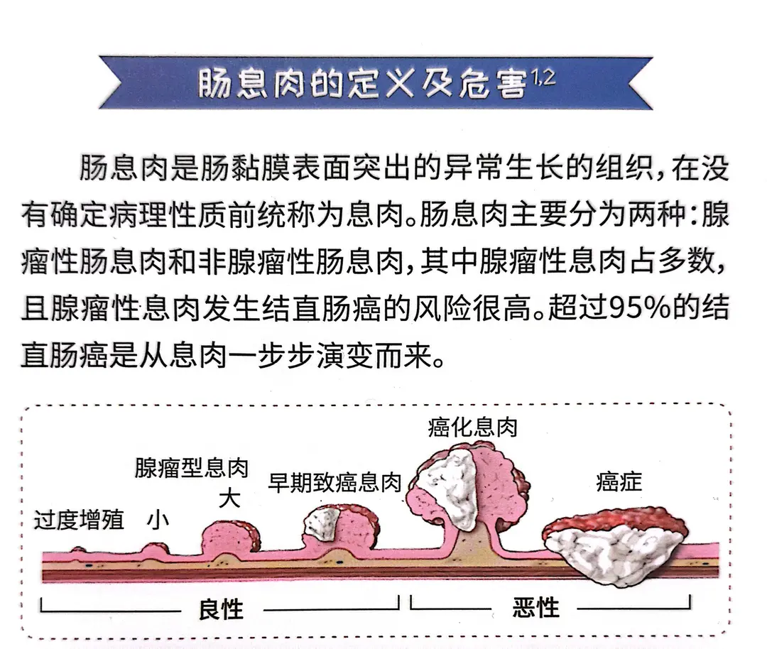 肠息肉相关知识