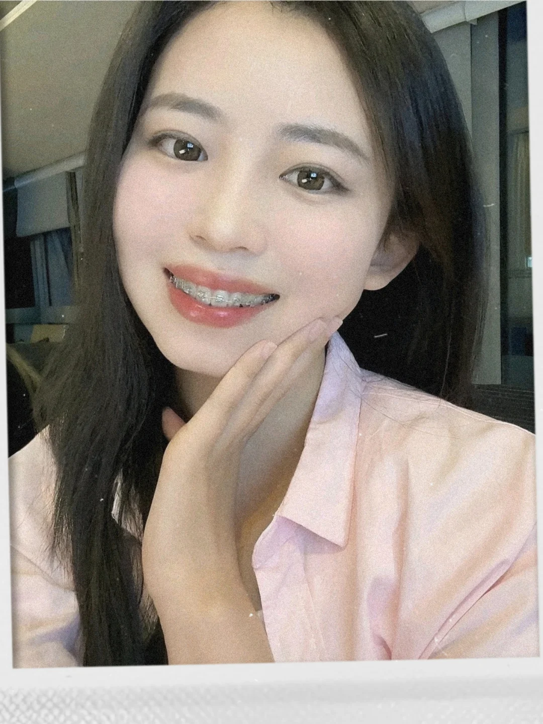 东莞学生党整牙记：不拔牙1.5w+，告别凸嘴