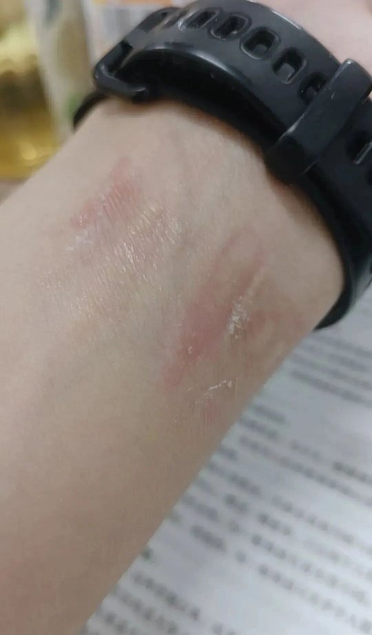 #第一批戴运动手环的受害者出现了#曾经以为运动手环是自律神器，可第一批长期佩戴的人，慢慢遇到了现实的代价。
 
不少人手腕一圈皮肤发白粗糙、发痒泛红，甚至角质增厚。并不是网传绿光灼伤，大多是24小时不摘，表带密闭闷汗、反复摩擦，诱发接触性皮炎 。
比皮肤损伤更隐蔽的，是数据带来的精神内耗 ​