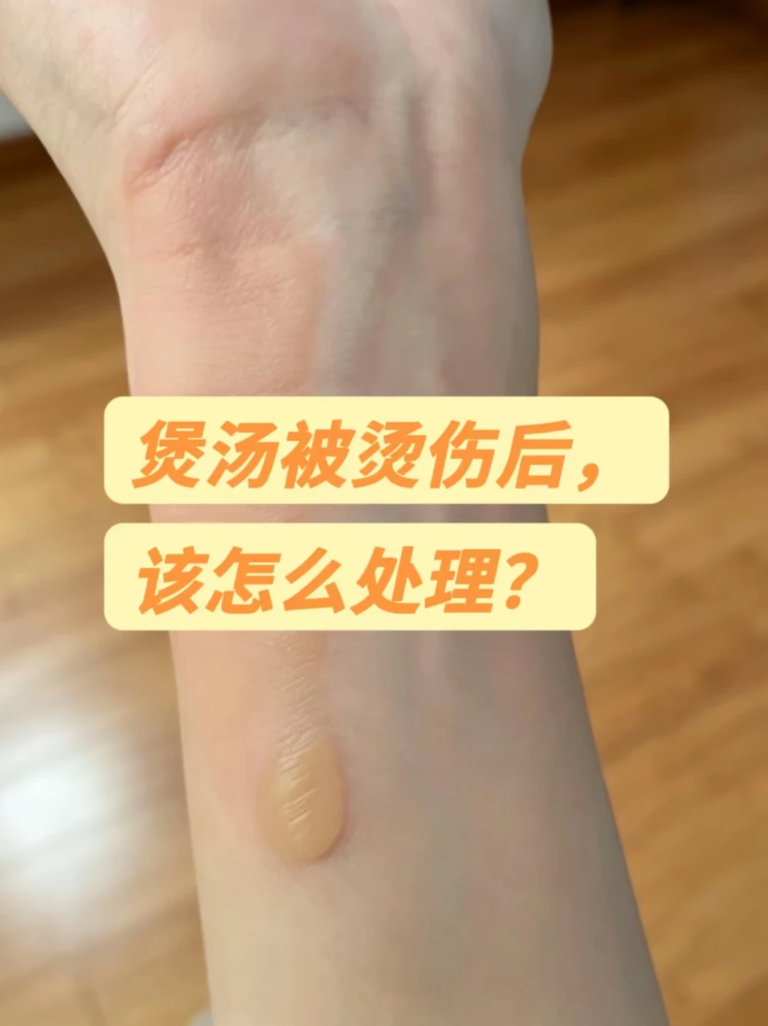 养生人惨案:煲汤烫出浅二度,但这笔账我没亏