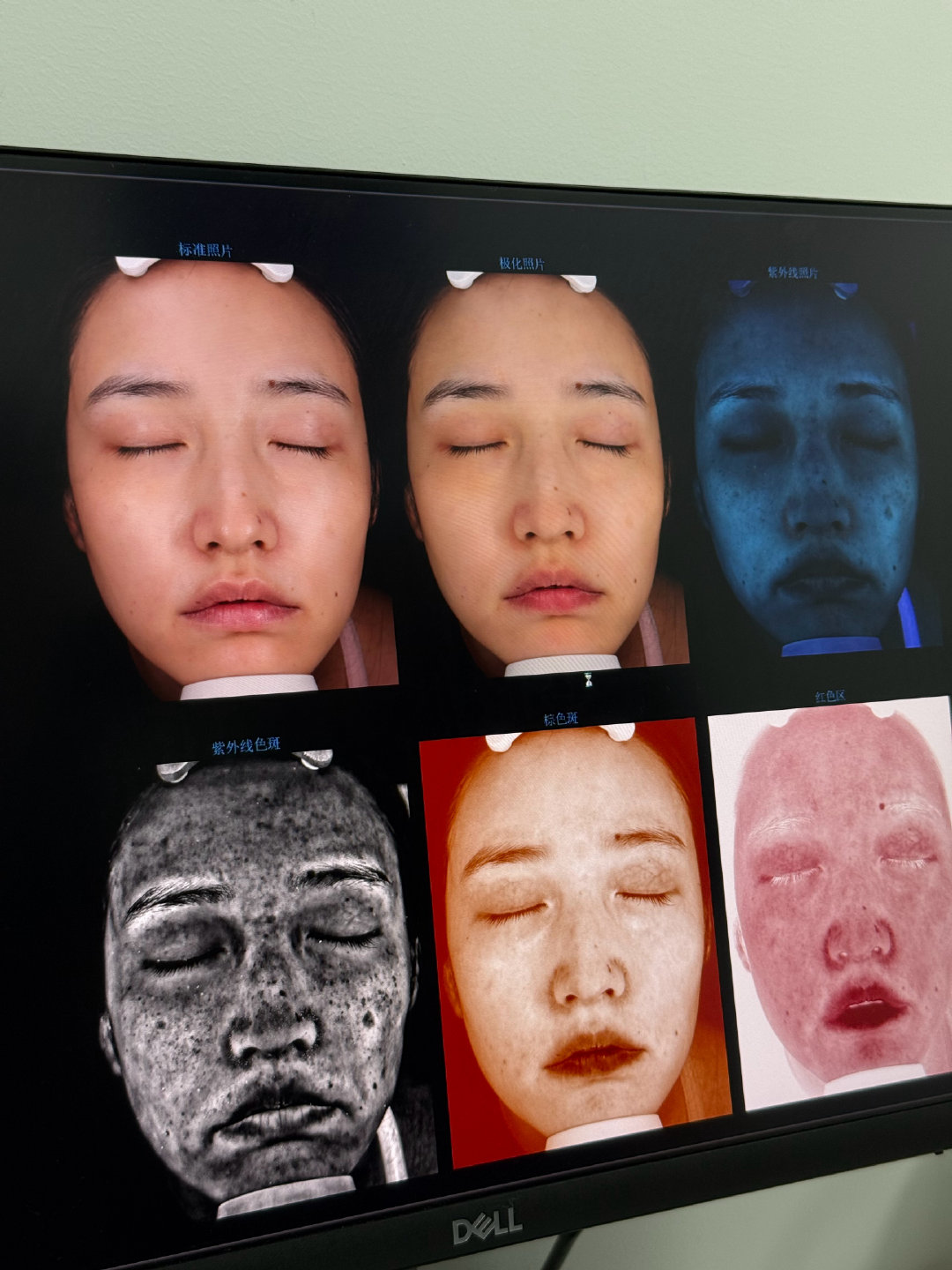 想均匀肤色 变白
今天做了皮秒和水光

但是他们现场想升单 跟我说脸上脖子上有扁平疣 让我用激光点 3000块包干净
我婉拒了 点疣 我准备去公立医院刷医保[嘻嘻] ​