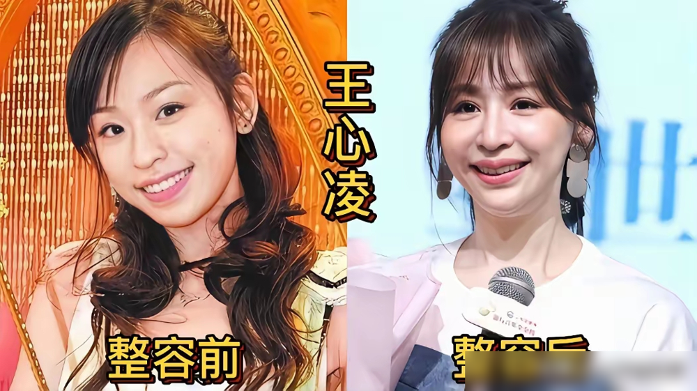 熊黛林整容前照片被扒出来了，腮帮子大得能当直角尺。再看现在那张鸭蛋脸，45岁敢放话：谁没做过呀？
沈梦辰最狠，旧照眼距宽到像开了鱼眼镜头，鼻梁塌得能滑滑梯。现在全切双眼皮一割，假体一垫，直接换了张建模脸。
柳岩倒是耿直，承认打过瘦脸针，拍戏怕表情僵就戒了。记者问她脸怎么还这么小，她回：胶原蛋白流