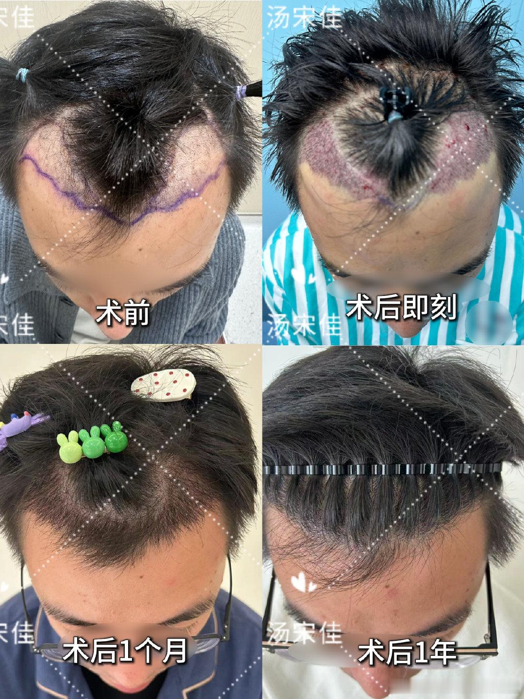 【发际线种植1年•1400单位】

📷很多男生雄秃最先垮的就是额角，我给这个求美者设计了 1400 单位植发。
跟着照片看完整恢复周期，熬过脱落期，一年之后新头发稳稳长出来啦。
很自然的发际线，不用再刻意遮遮掩掩啦，自信直接拉满。✨#杭州植发汤宋佳##杭州植发##汤宋佳博士植发打卡##植发术后# ​