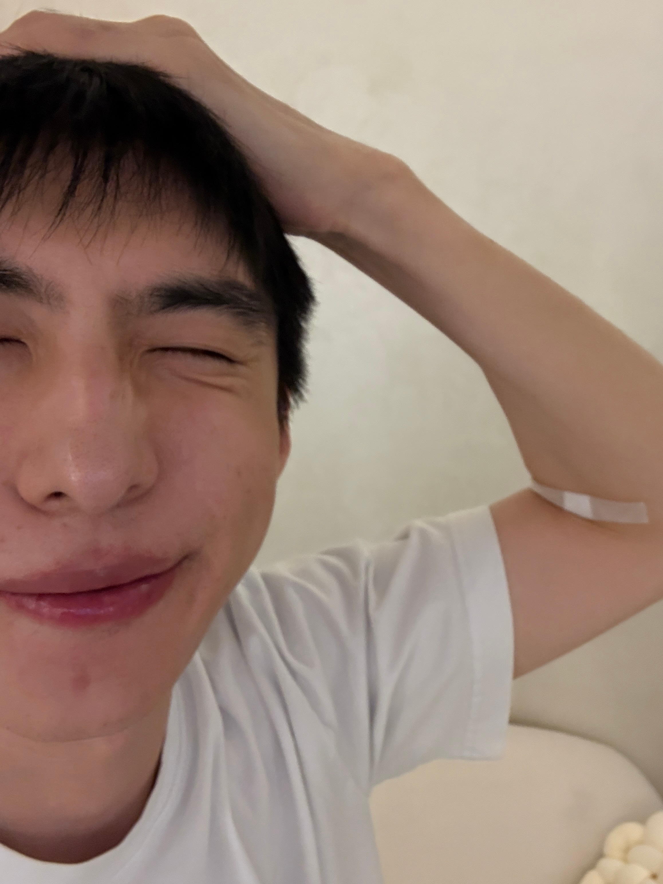 一会和医生二人世界，准备打4.5瓶优法兰，头皮cgf，做下局部超声炮，营养针扎一下，3型胶原（口周抗衰+软化疤痕粘连）。医生说caha轮廓提升，这个是保守用量，我说我赚钱就是为了这一刻，不保守的用量是多少。 ​​​