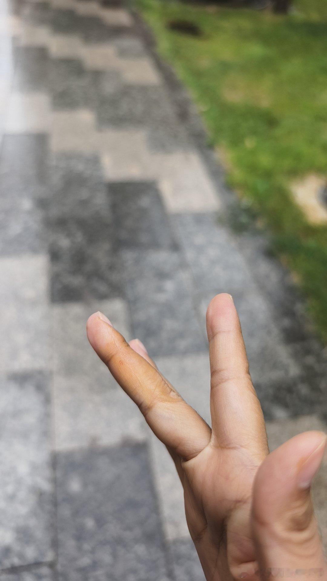 [苦涩]刚打了狂犬疫苗第一针，无妄之灾。 ​