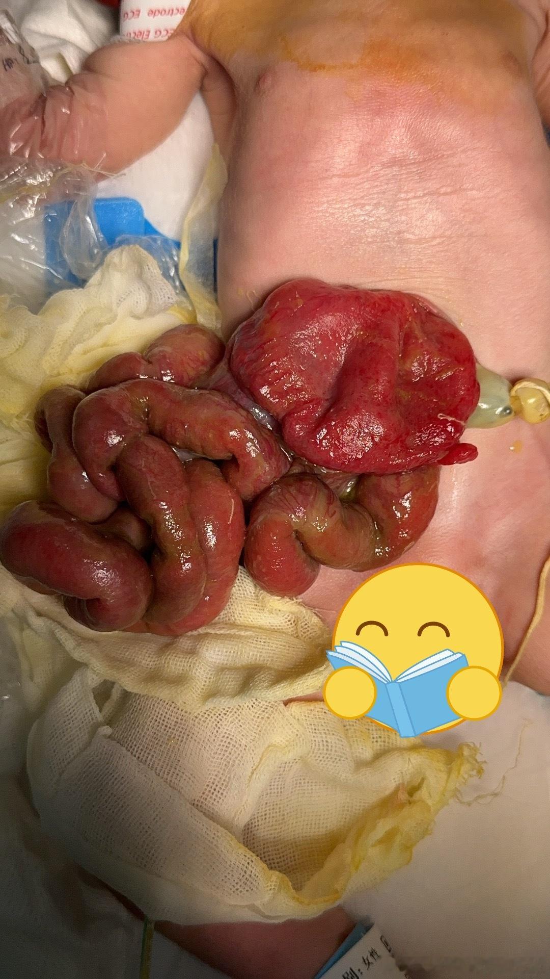【信仰】

新生儿腹裂发病率低
属于罕见病
在上世纪40年代
该病的死亡率是90%
 随着医疗技术进步
目前该病存活率是90%。

家属是藏人
信奉藏传佛教
永不杀生（放弃治疗）
行了一期腹裂修补术

多年前一个女富豪
孙女胎儿期是重症膈疝
产前评估出生后存活率低下
暗示家属放弃（流产）
富豪信奉佛教
坚持 ​
