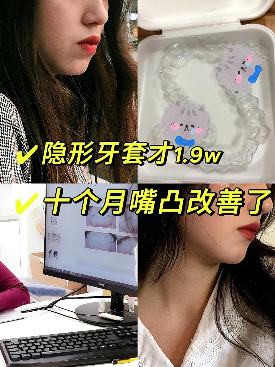 西安隐形整牙仅1.9w，十个月改善了凸嘴