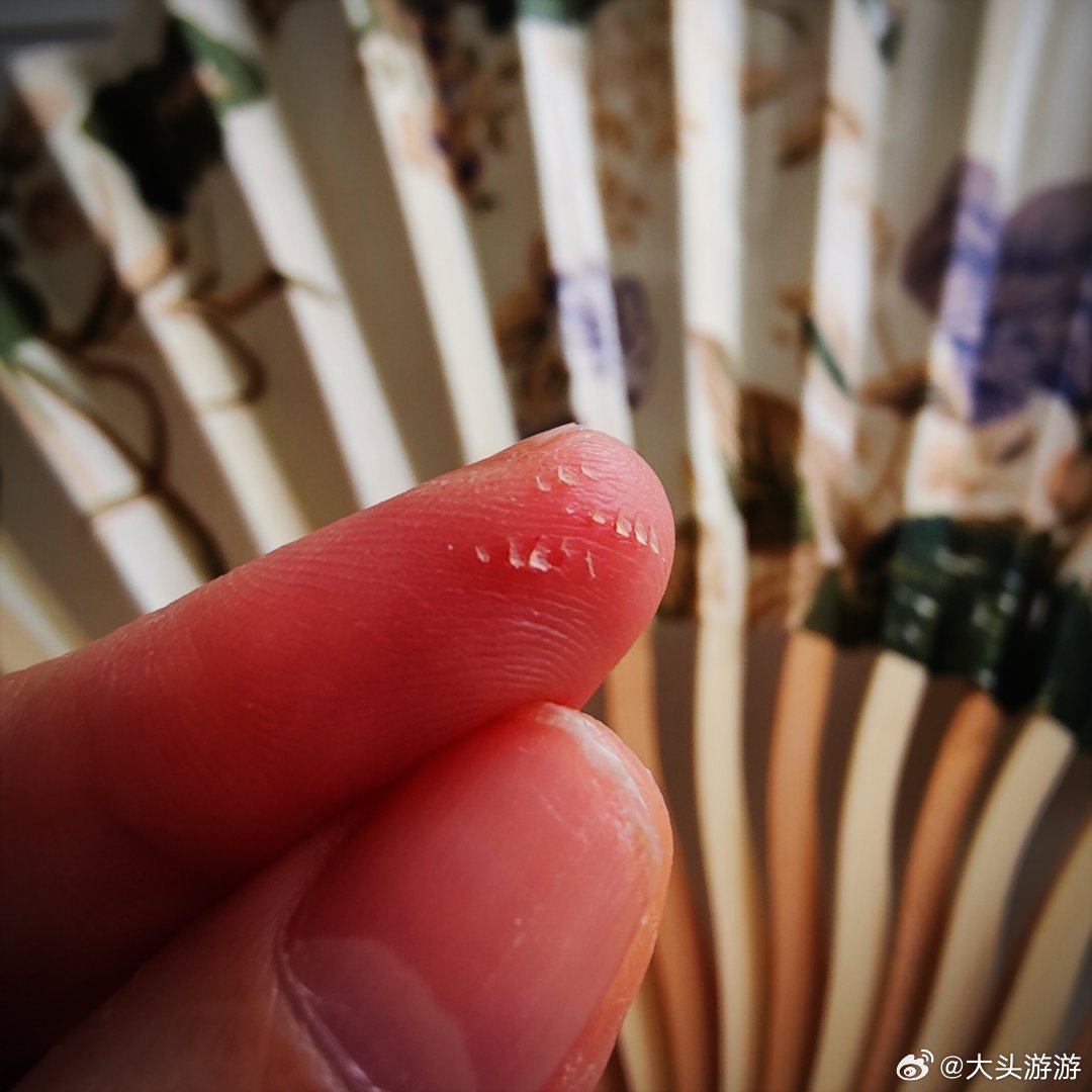 #所遇所虑#
继信封或者纸张刮破皮肤后，我也偶尔发现些无法跟凶器联想起来的微小伤口。
刚在给土豆削皮的现场，我发现了这个带芽的伤口，被果刀弄到的。
所以之前那些都是我用大小刀弄的。并不是我肤质多么娇嫩。
我还以为是我缺啥营养/微量元素呢。其实，应该只是缺脑子。
应了那句“食野5做野……” ​