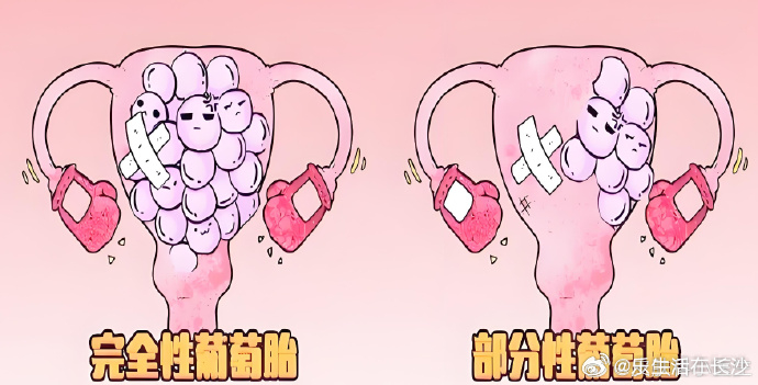 【葡萄胎也是一种“胎”，可以继续妊娠吗？】葡萄胎并不是真正意义上的 ...