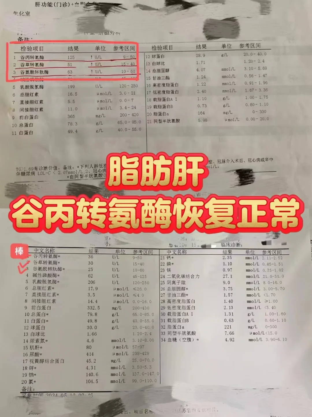 脂肪肝转氨酶不升反降我是怎么做到的？