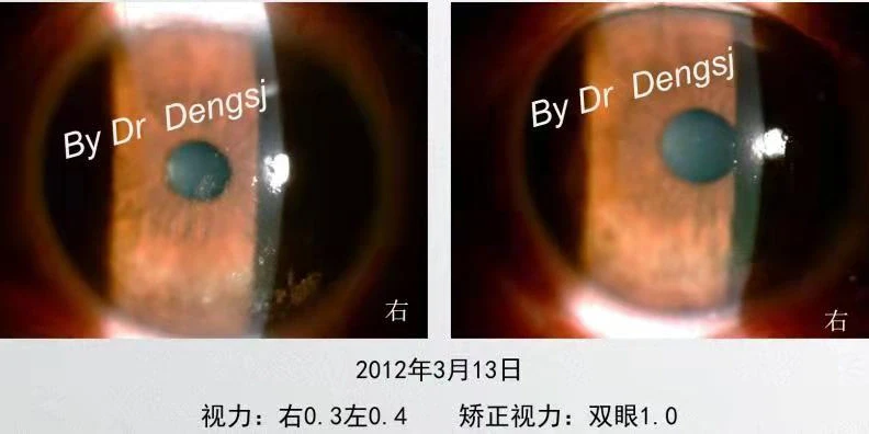 不遵医嘱用药的干眼患者