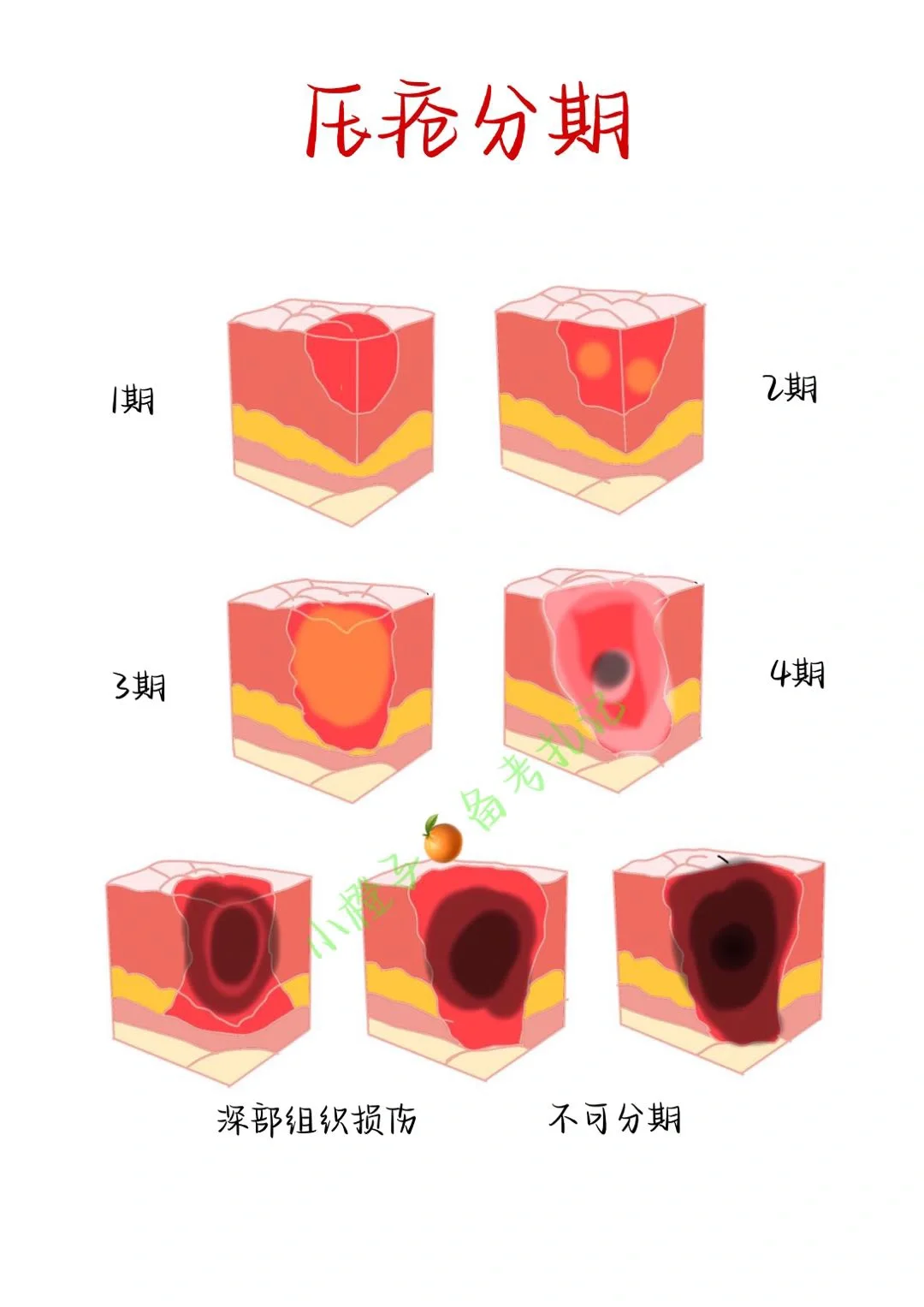 📖基础护理学｜压疮分期｜你学会了吗❓