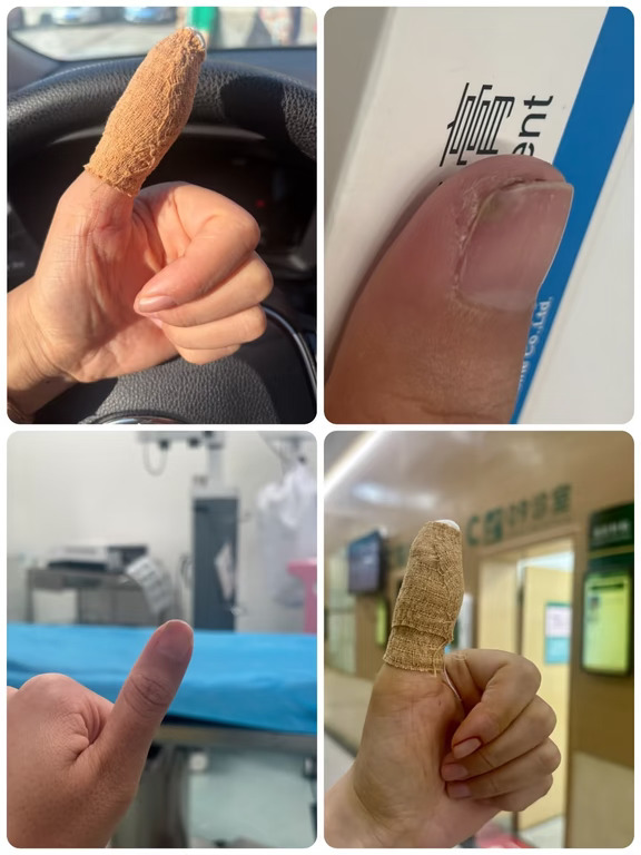 用清创排脓后的拇指给自己点赞