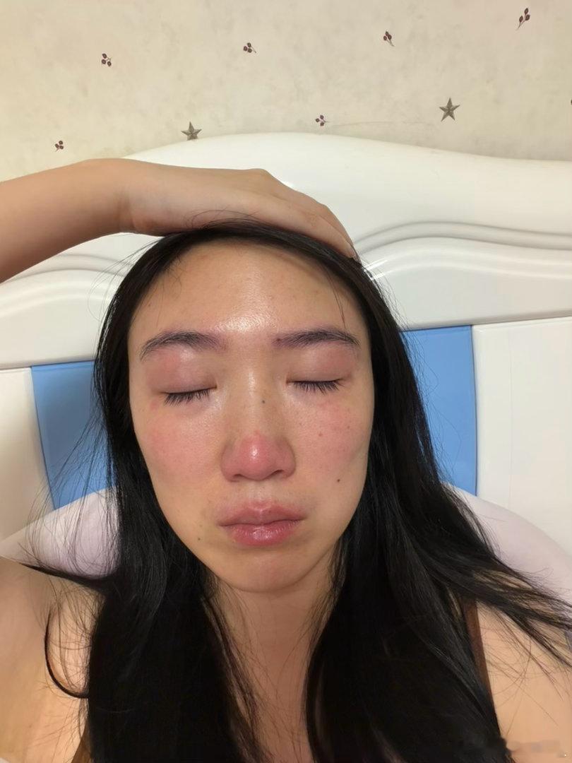 破地狱哭出神经性皮炎 ​