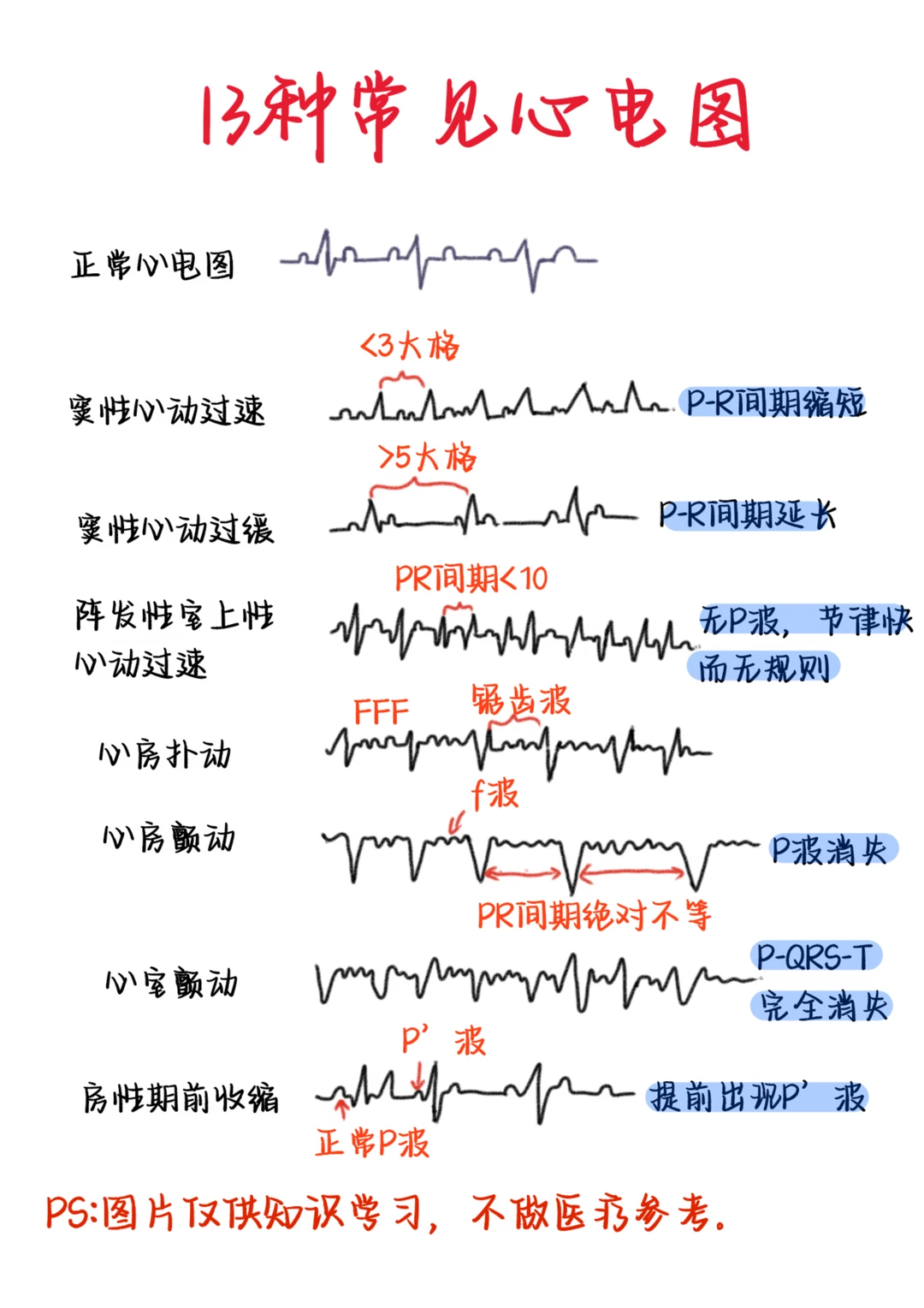医学生笔记——13种常见心电图