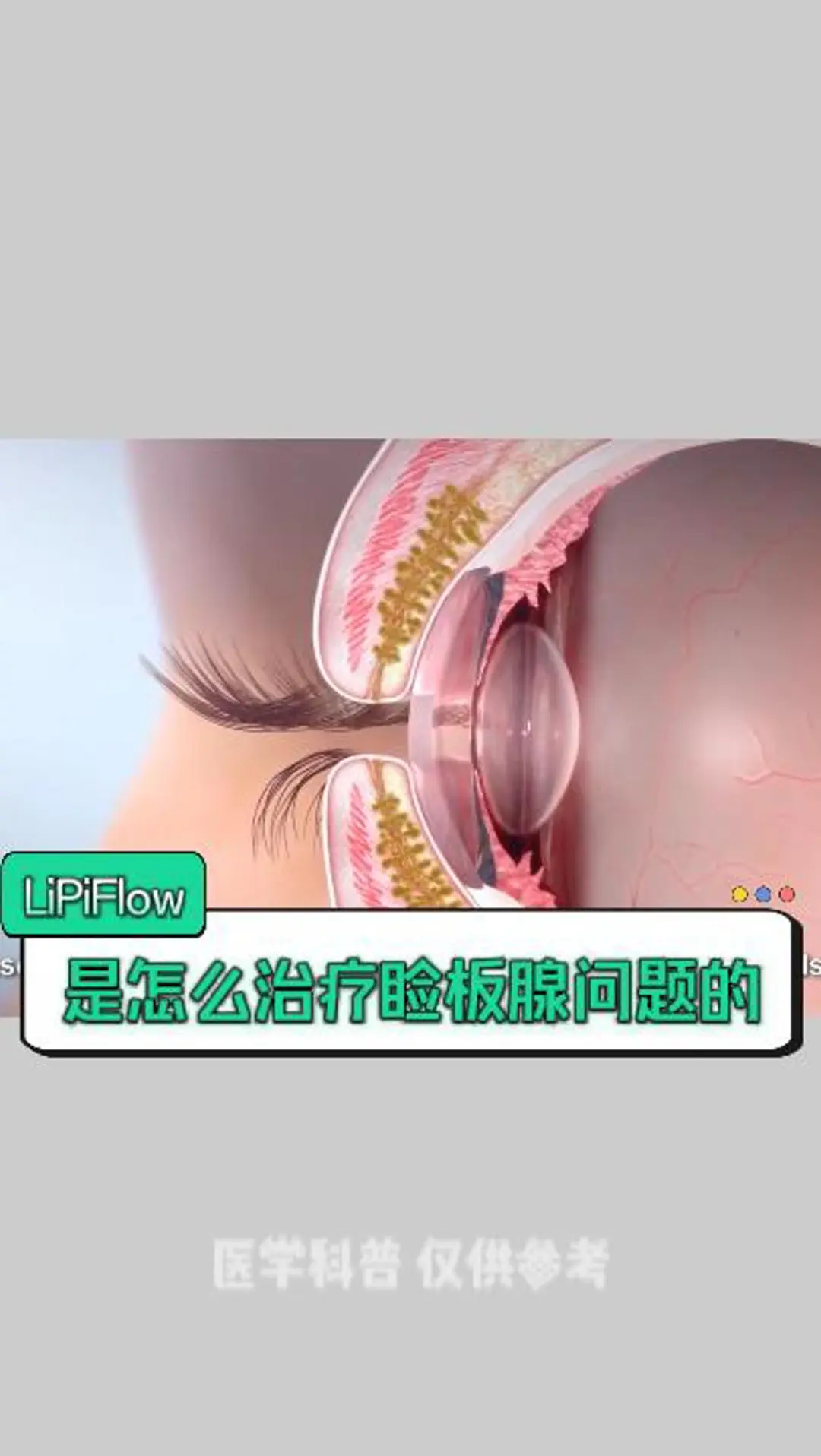 LipiFlow治疗干眼原理