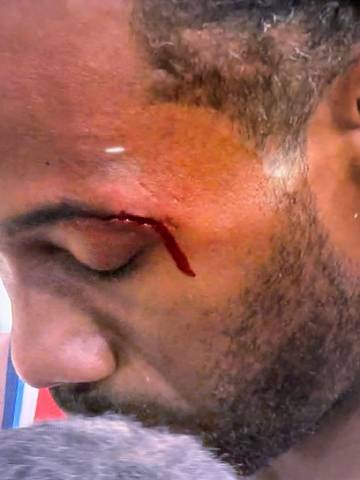 被开眼角了…紧急下场处理下伤口