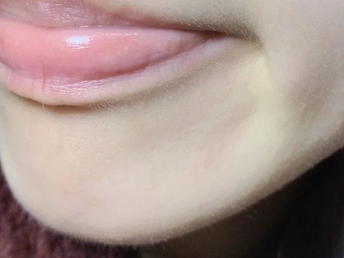 强推一个韩国的下巴闭口溶解剂