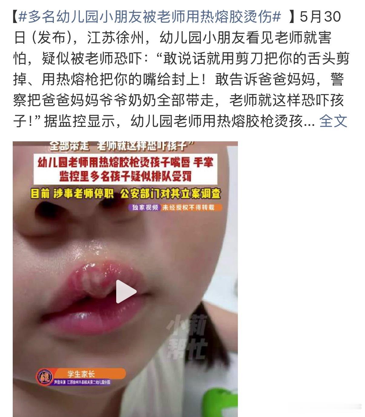 这怎么能当上老师的？还是幼师！ 被热熔胶烫到过的就知道这玩意烫到...