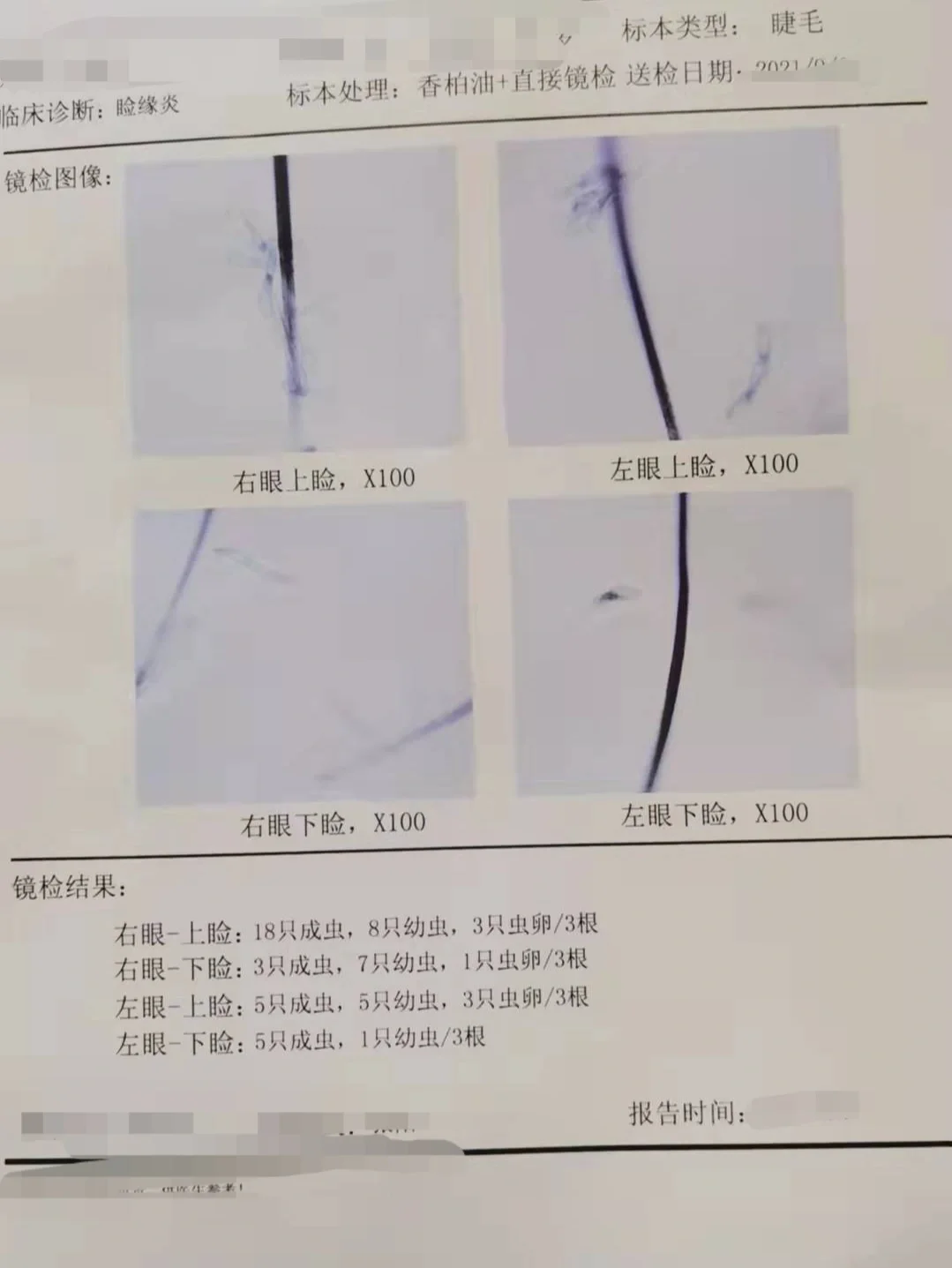3根睫毛，能查出来多少螨虫？