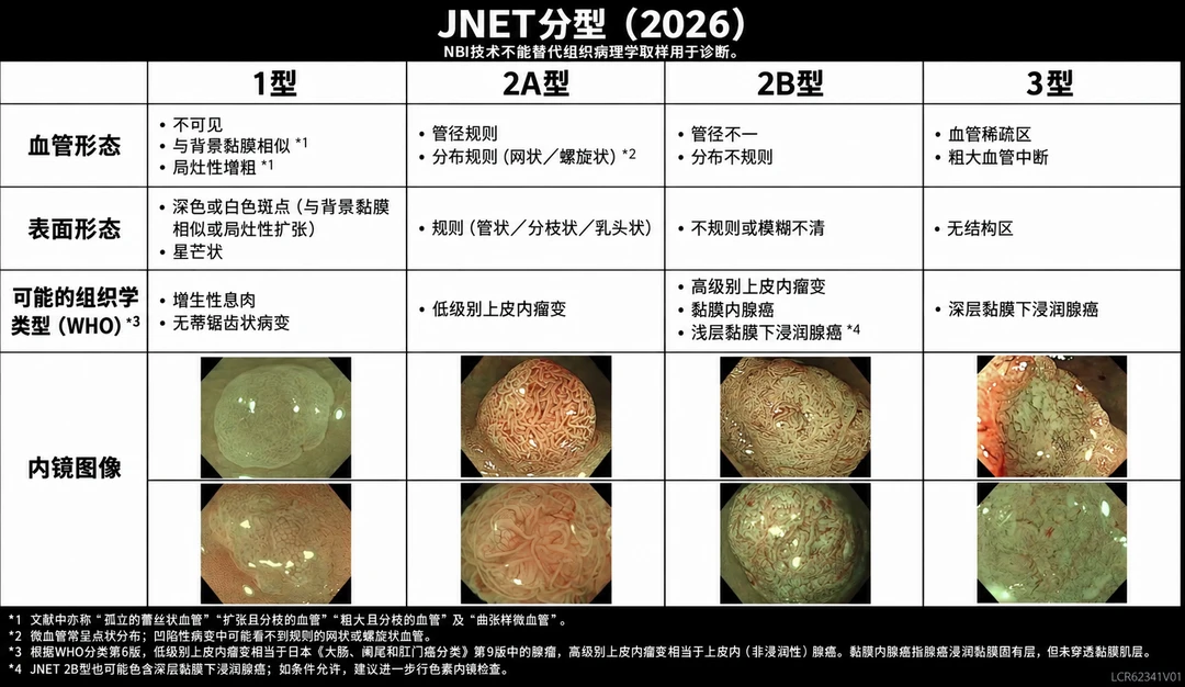 简单又实用的肠息肉分型——JNET分型