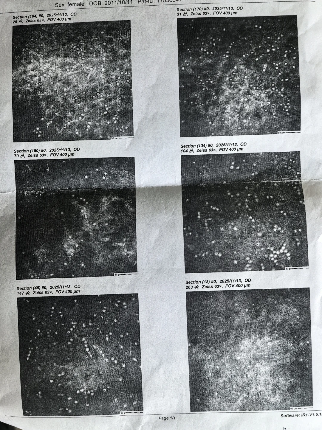 护理 OK 镜要心细，警惕阿米巴角膜炎