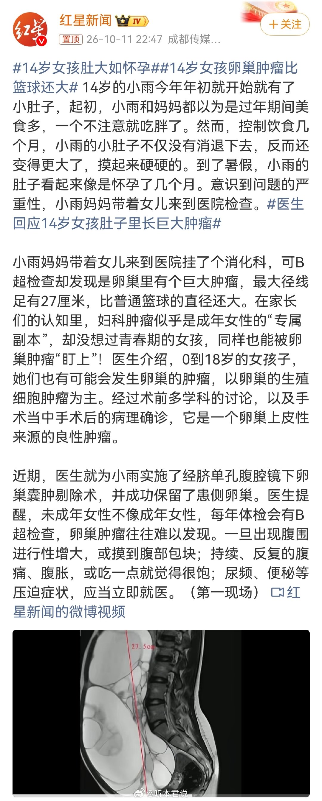 这种情况有两种可能，一种是真怀孕，但可能性很小。另一种可能性是假怀孕，是病变引起的，肿瘤变大造成的。小小年纪会这样，跟家族遗传史有关联。#14岁女孩肚大如怀孕# ​